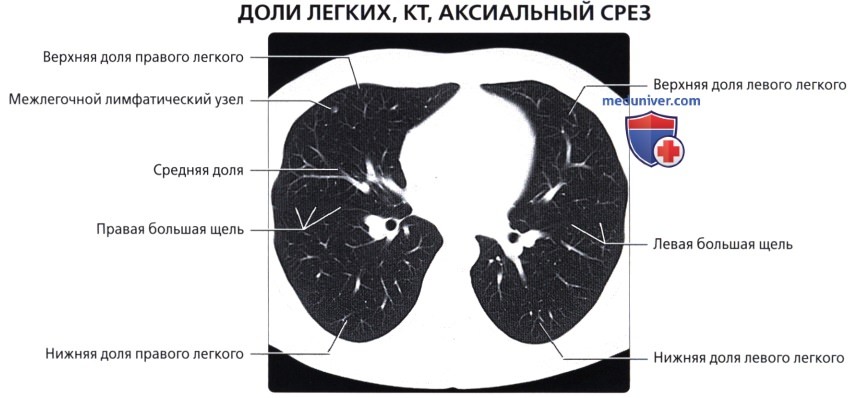 Лучевая анатомия (рентген, КТ анатомия) легких