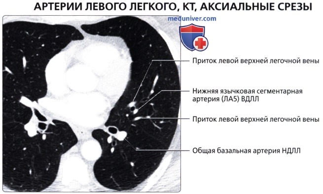 Лучевая анатомия (рентген, КТ анатомия) легочных сосудов