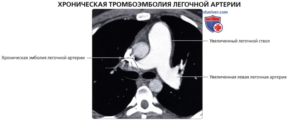 Лучевая анатомия (рентген, КТ анатомия) легочных сосудов
