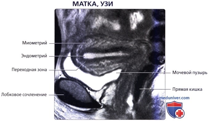 Лучевая анатомия (КТ, МРТ анатомия) матки