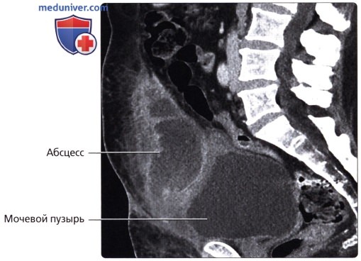 Лучевая анатомия (КТ, МРТ анатомия) мочеточника и мочевого пузыря