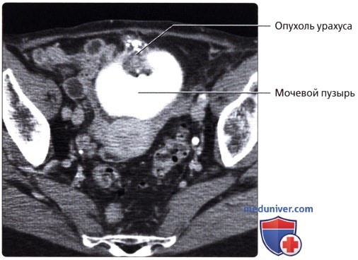 Лучевая анатомия (КТ, МРТ анатомия) мочеточника и мочевого пузыря