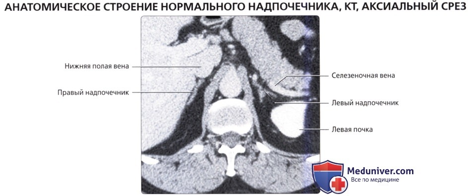 Лучевая анатомия (КТ, МРТ анатомия) надпочечника