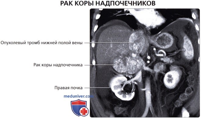 Лучевая анатомия (КТ, МРТ анатомия) надпочечника