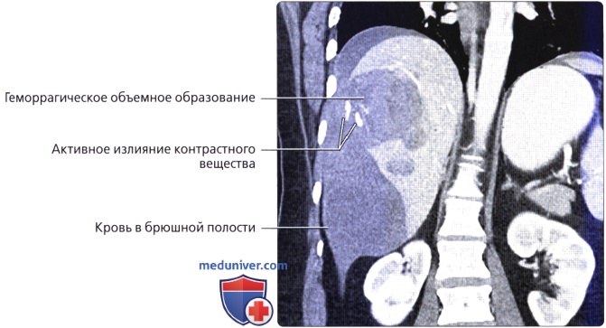 Лучевая анатомия (КТ, МРТ анатомия) печени
