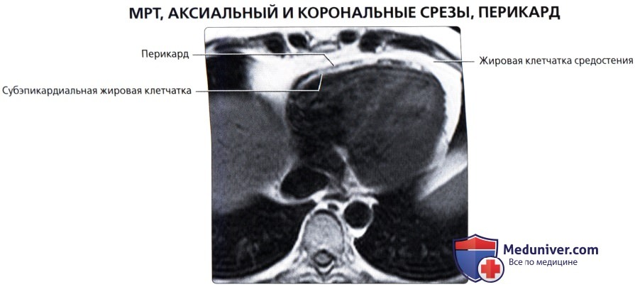 Лучевая анатомия (КТ, МРТ анатомия) перикарда