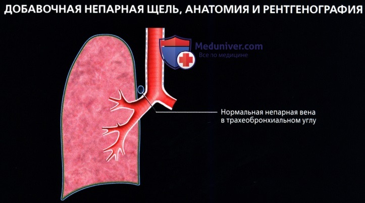 Лучевая анатомия (рентген, КТ анатомия) плевры