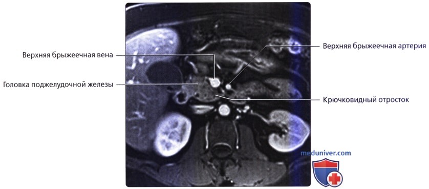 Лучевая анатомия (КТ, МРТ анатомия) поджелудочной железы