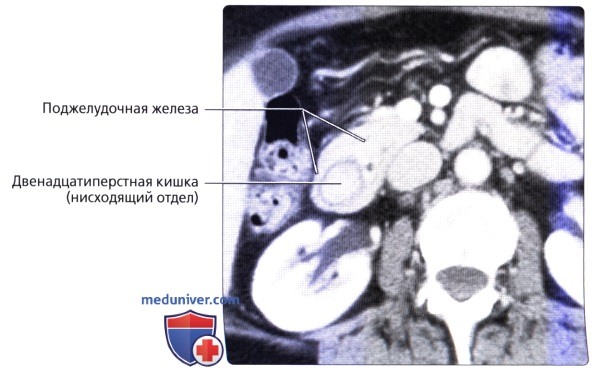 Лучевая анатомия (КТ, МРТ анатомия) поджелудочной железы