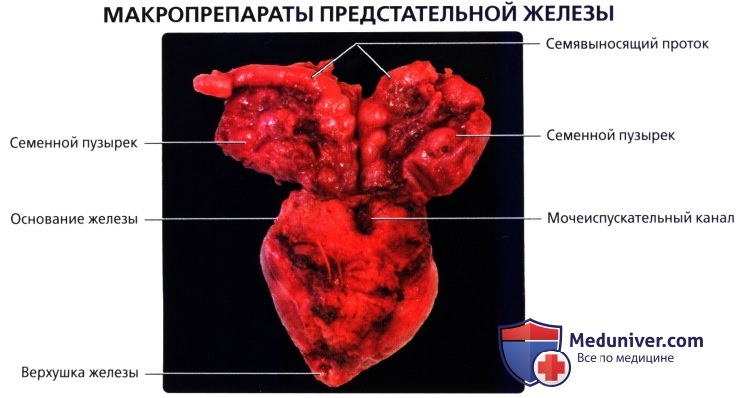 Лучевая анатомия (КТ, МРТ анатомия) предстательной железы и семенных пузырьков