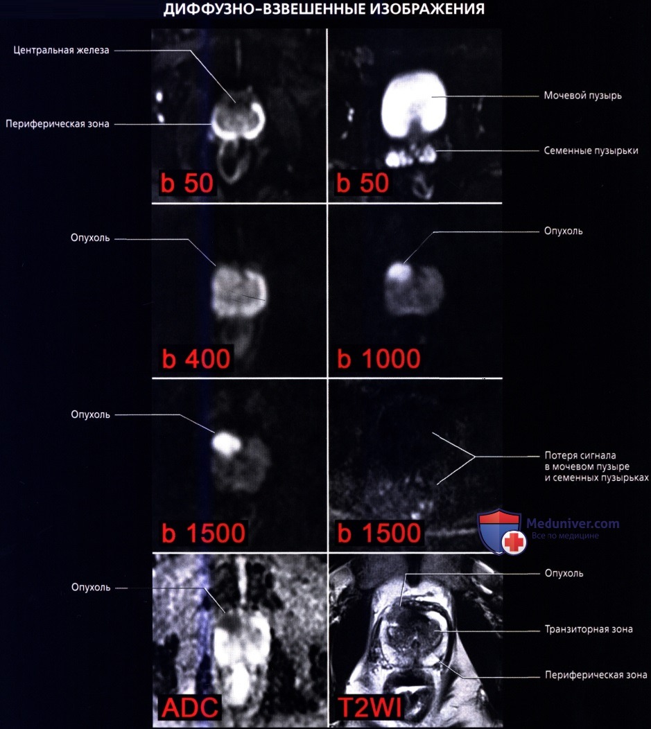 Лучевая анатомия (КТ, МРТ анатомия) предстательной железы и семенных пузырьков