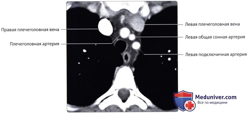 Лучевая анатомия (рентген, КТ анатомия) сосудов большого круга кровообращения в грудной клетке