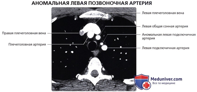 Лучевая анатомия (рентген, КТ анатомия) сосудов большого круга кровообращения в грудной клетке