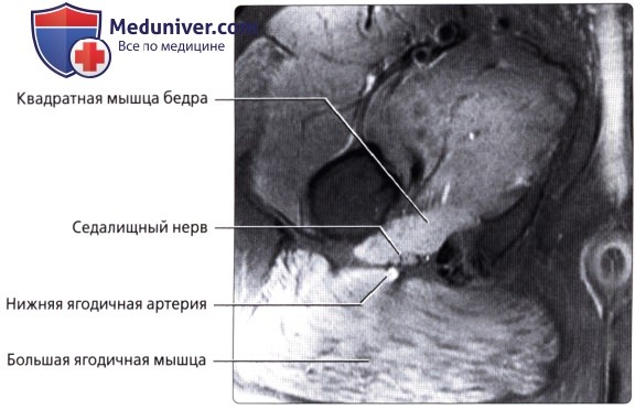 Лучевая анатомия (КТ, МРТ анатомия) сосудов, лимфатических узлов, нервов полости таза