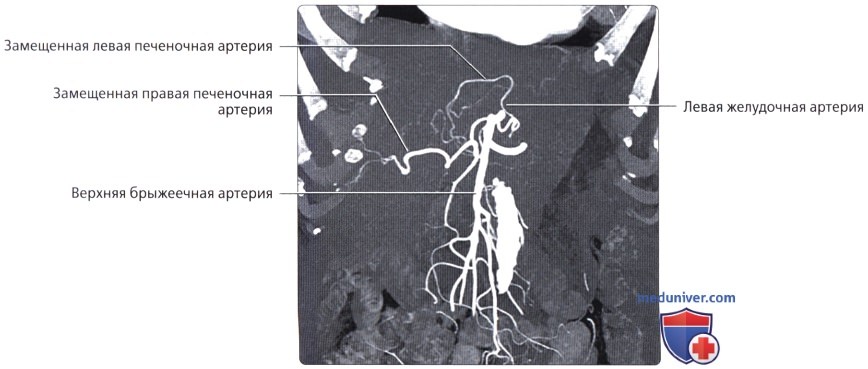 Лучевая анатомия (КТ, МРТ анатомия) сосудов, нервов, лимфатических узлов брюшной полости