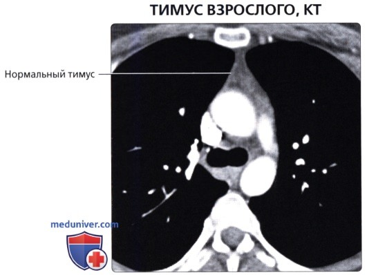 Лучевая анатомия (рентген, КТ анатомия) средостения