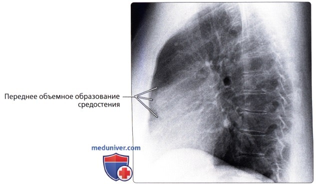 Лучевая анатомия (рентген, КТ анатомия) средостения