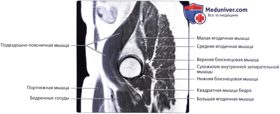 Лучевая анатомия (КТ, МРТ анатомия) стенок таза и тазового дна у мужчин
