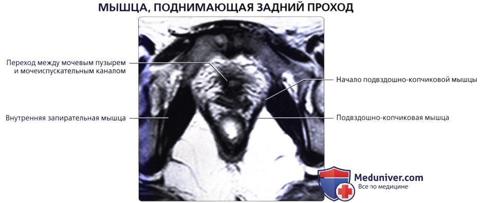 Лучевая анатомия (КТ, МРТ анатомия) тазового дна у женщин