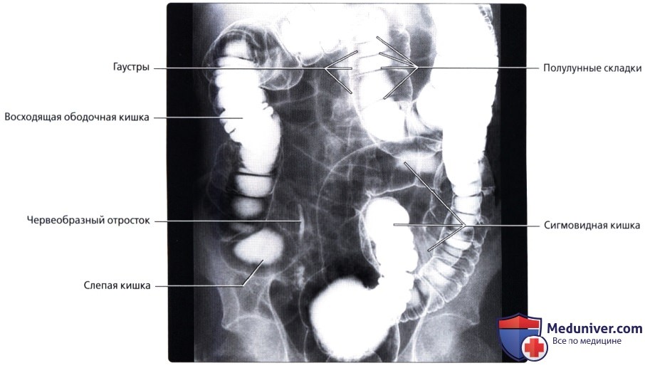 Лучевая анатомия (рентген, КТ анатомия) толстой кишки