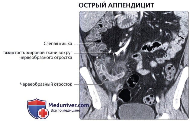 Лучевая анатомия (рентген, КТ анатомия) толстой кишки
