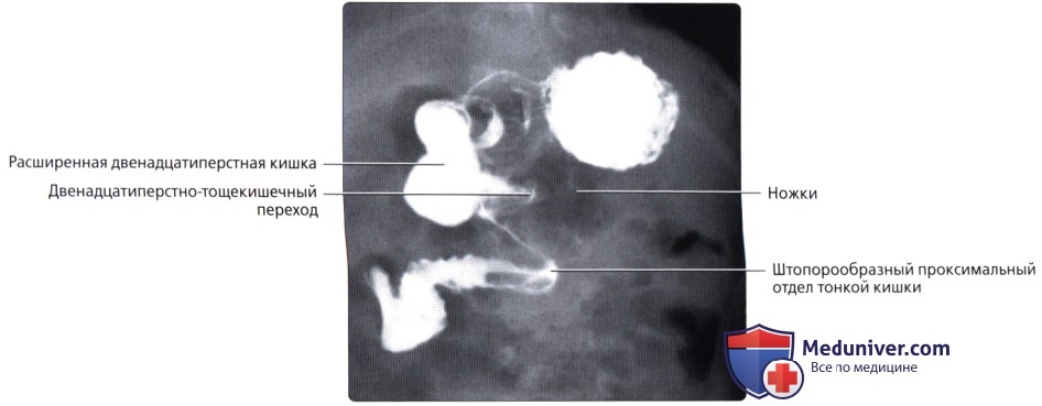 Лучевая анатомия (рентген, КТ анатомия) тонкой кишки