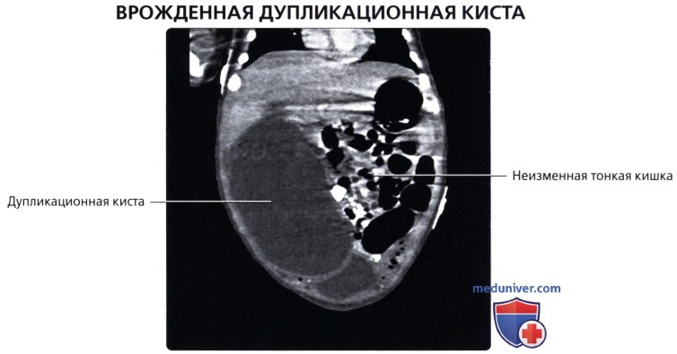 Лучевая анатомия (рентген, КТ анатомия) тонкой кишки
