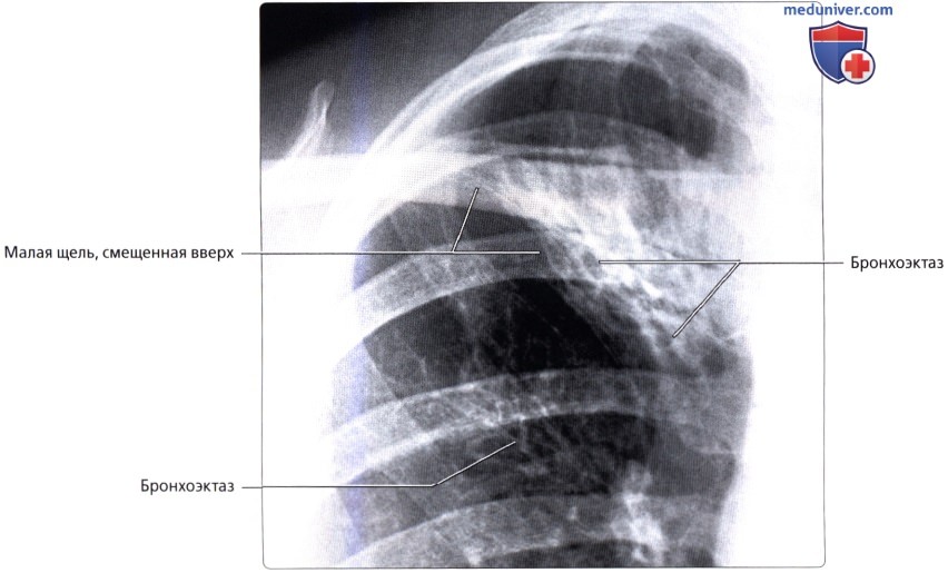 Лучевая анатомия (рентген, КТ анатомия) трахеи и бронхов