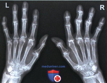 Маркировка и оценка правильности установки маркеров на рентгенограмме