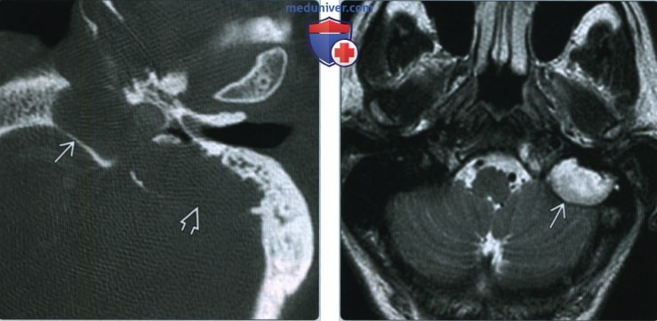 Врожденная мастоидальная холестеатома - лучевая диагностика