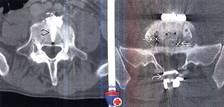 Рентгенограмма, КТ межтеловых спейсеров позвоночника