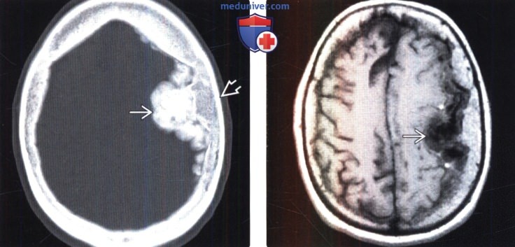 Менингиома головного мозга фото мрт thumbnail