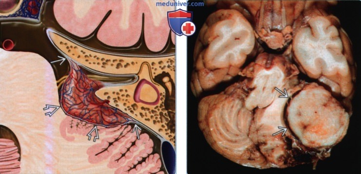 Менингиома мостомозжечкового угла (ММУ) и внутреннего слухового канала (ВСК) - лучевая диагностика