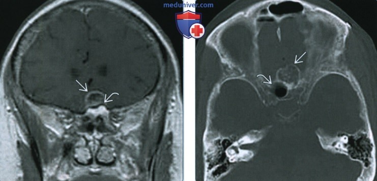 Менингиома основания черепа - лучевая диагностика
