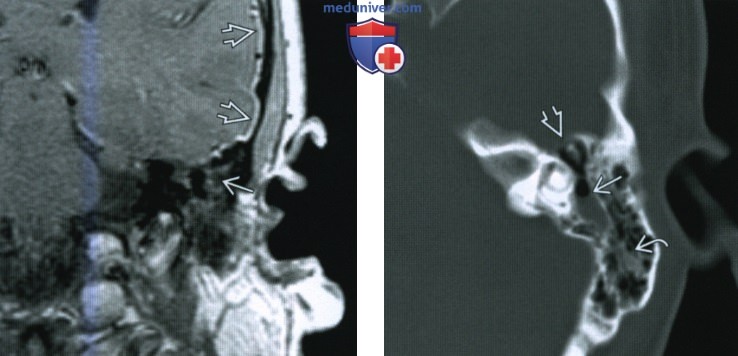 Менингит мостомозжечкового угла (ММУ) и внутреннего слухового канала (ВСК) - лучевая диагностика