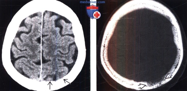 КТ признаки метастазов в череп и мозговые оболочки