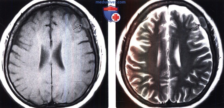 МРТ признаки метастазов в череп и мозговые оболочки