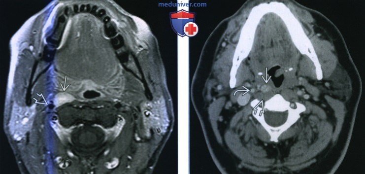 Метастазы неплоскоклеточного рака в заглоточные лимфоузлы - лучевая диагностика