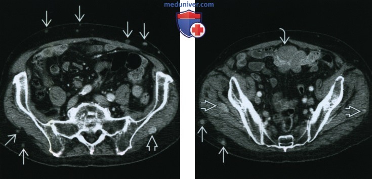 Метастазы опухоли в мягких тканях - лучевая диагностика