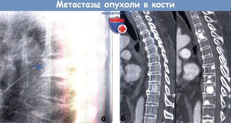 Остеобластические метастазы позвоночника рентген. Метастазы молочной железы в кости на кт. Метастатическое поражение костей кт.
