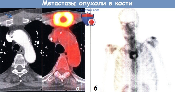 Метастазы опухоли в кости на ПЭТ, КТ, остеосцинтиграфии