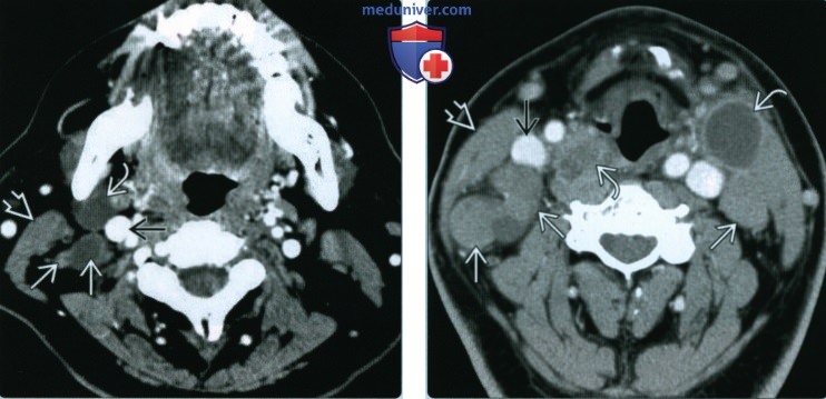 Метастазы плоскоклеточного рака в лимфоузлы добавочной цепи - лучевая диагностика