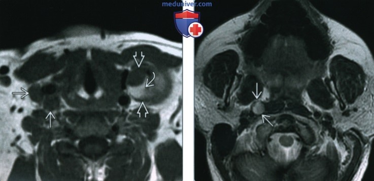 Метастазы дифференцированного рака щитовидной железы в лимфоузлы шеи - лучевая диагностика