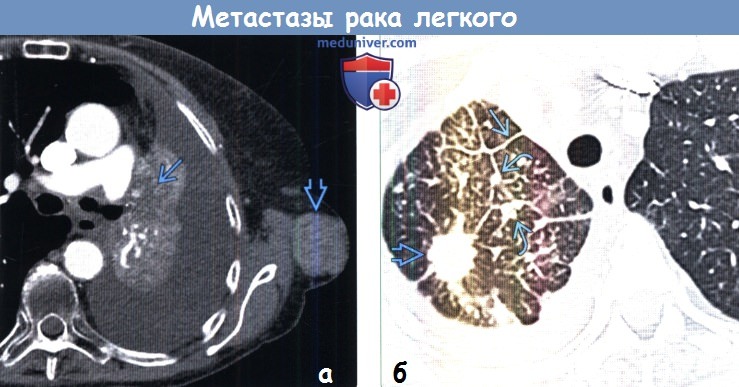 Метастазы рака легкого на КТ и ПЭТ