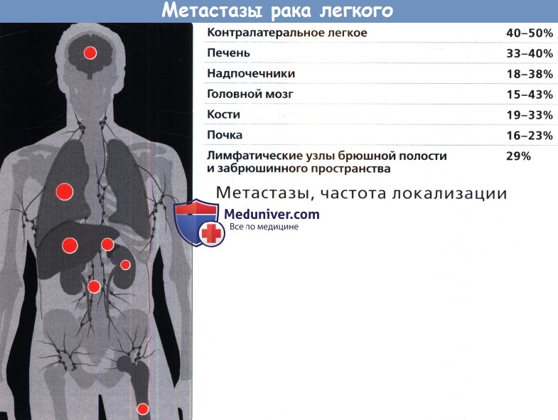 Рак 4 стадии с метастазами форум. Метастазирующие опухоли.