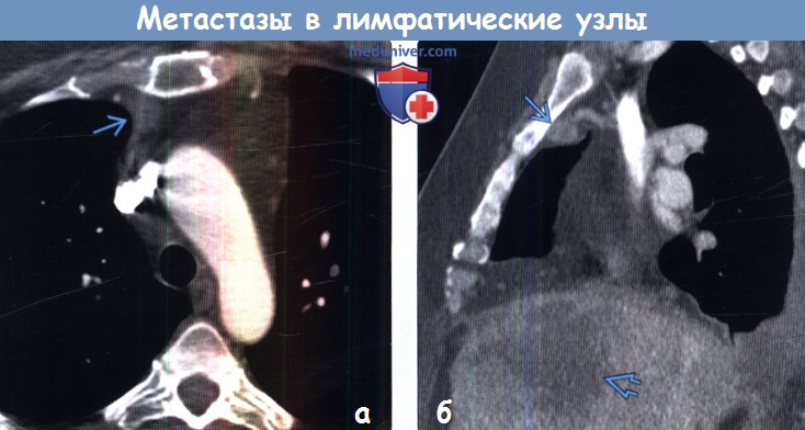 Метастаз рака в лимфатический узел. Лимфоузлы брюшной полости на кт. Метастазы в лимфатические узлы брюшной полости кт. Метастазы во внутригрудные лимфоузлы. Метастазированные лимфоузлы на кт.