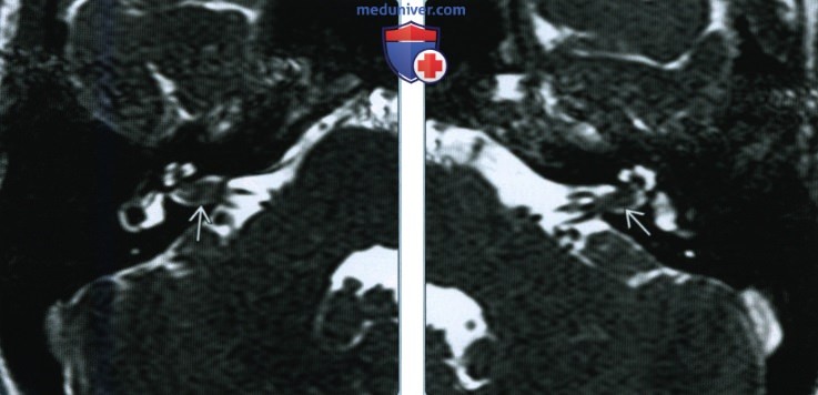 Метастазы в мостомозжечковый угол (ММУ) и внутренний слуховой канал (ВСК)