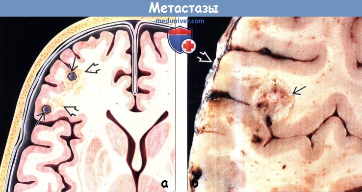 Метастазы в паренхиму головного мозга на МРТ