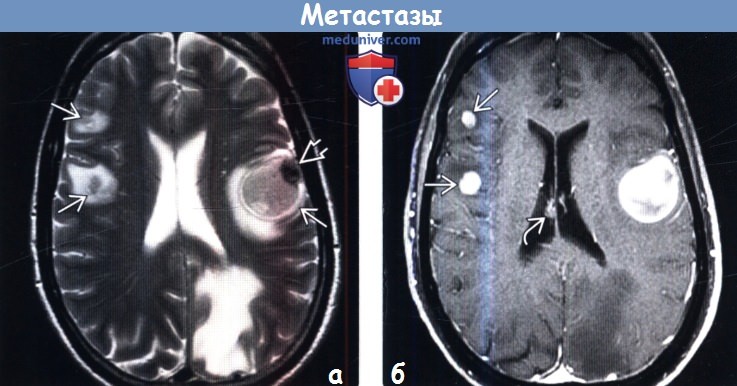 Меланома метастазы в мозг. Метастазы меланомы в головной мозг кт. Метастазы меланомы в головной мозг мрт. Множественные метастазы в головной мозг кт.