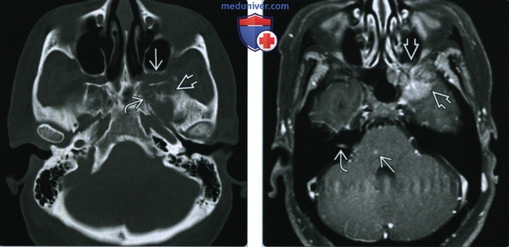 Метастазы в основании черепа - лучевая диагностика